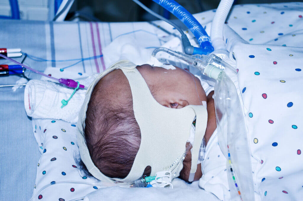Baby in hospital bed with oxygen tubes